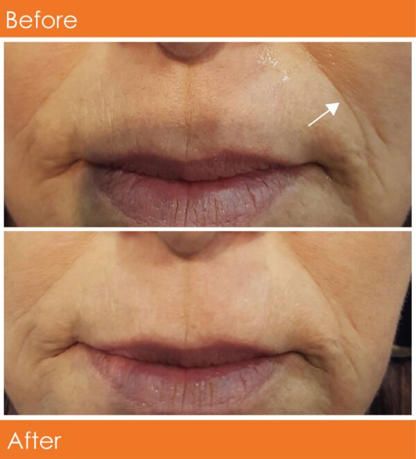 A2006 SR417 Instant lifting Serum