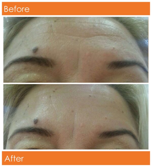 A2006 SR417 Instant lifting Serum